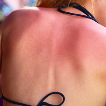 10 Weird Places You're Definitely Forgetting to Apply Sunscreen