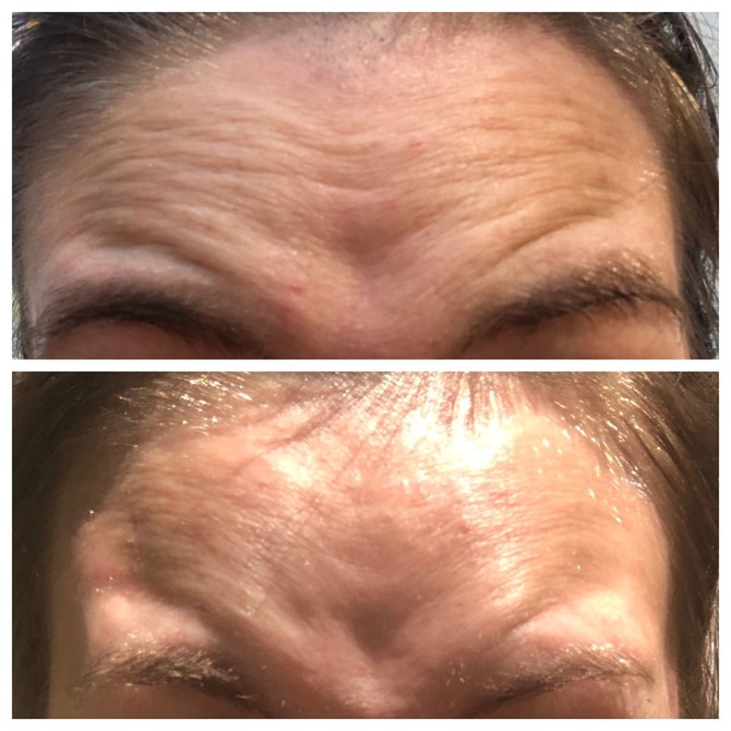 Gold Bond Neck Firming Cream Before & After