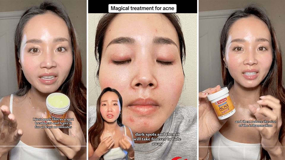 De La Cruz Acne Treatment TikTok